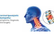 Understanding Cervical Spondylotic Myelopathy: Symptoms, Diagnosis and Treatment