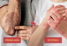 Psoriasis vs Eczema: What's the Difference?