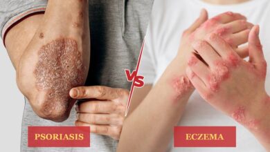 Psoriasis vs Eczema: What's the Difference?