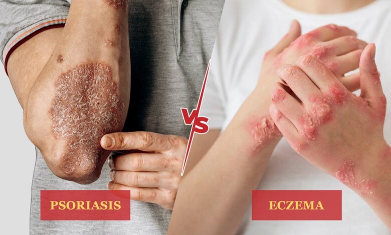 Psoriasis vs Eczema: What's the Difference?