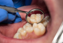 United States Veterans Dental Care Access: Planning and Paying for Treatment