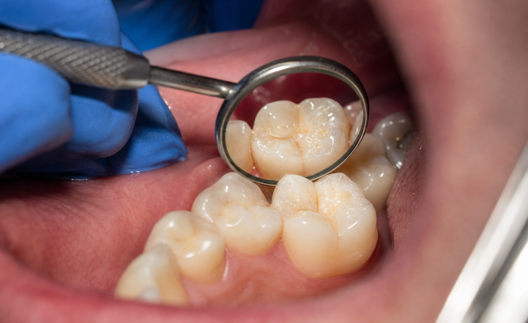 United States Veterans Dental Care Access: Planning and Paying for Treatment
