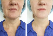 Nefertiti Lift How It Works for Jawline and Neck Definition