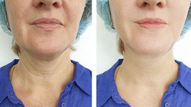 Nefertiti Lift How It Works for Jawline and Neck Definition