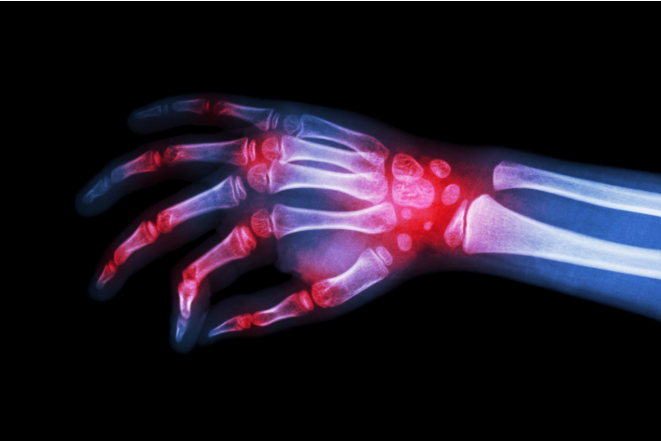 Occupational Therapy for Rheumatoid Arthritis