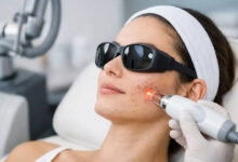Can Laser Resurfacing Improve Acne Scars and Uneven Skin Texture?