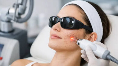 Can Laser Resurfacing Improve Acne Scars and Uneven Skin Texture?