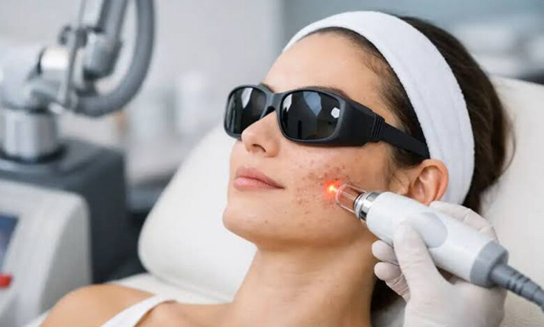 Can Laser Resurfacing Improve Acne Scars and Uneven Skin Texture?