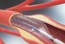 Returning to Work After Angioplasty: Factors That Can Affect Recovery