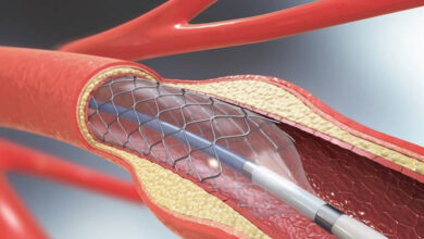 Returning to Work After Angioplasty: Factors That Can Affect Recovery
