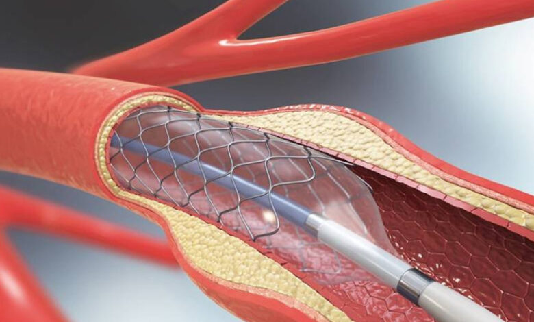 Returning to Work After Angioplasty: Factors That Can Affect Recovery